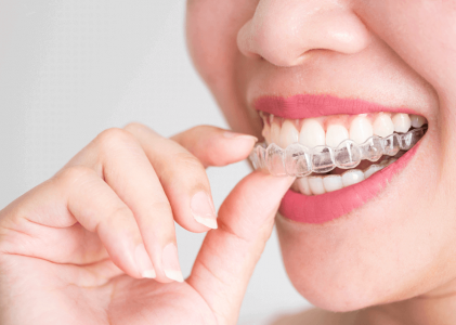 Cum poti avea zambetul dorit cu ajutorul unui aparat dentar Invisalign?